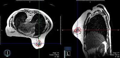 MRI-LINAC: A transformative technology in radiation oncology